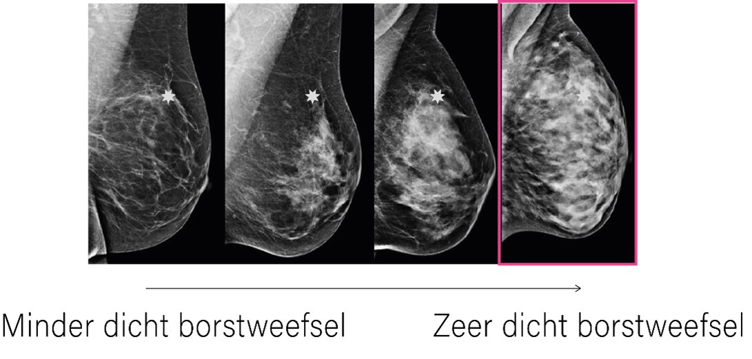 Illustratie: röntgenfoto van borstweefsel. Van minder dicht tot dicht